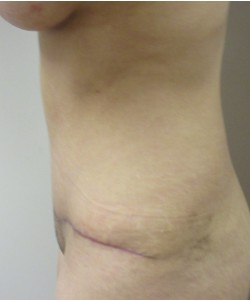 Tummy Tuck Patient 32 after photo. Individual results may vary.