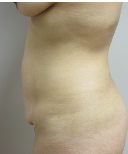 Tummy Tuck Patient 32 before photo. Individual results may vary.