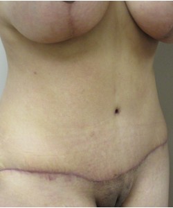 Tummy Tuck Patient 32 after photo. Individual results may vary.