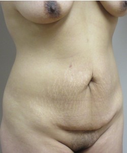 Tummy Tuck Patient 32 before photo. Individual results may vary.