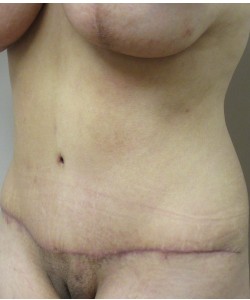 Tummy Tuck Patient 32 after photo. Individual results may vary.