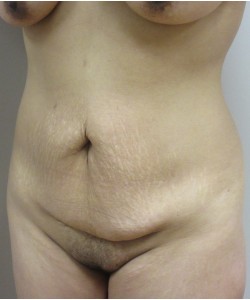 Tummy Tuck Patient 32 before photo. Individual results may vary.