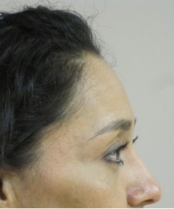 Blepharoplasty Patient 6 after photo. Individual results may vary.