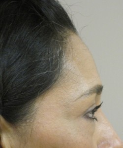 Blepharoplasty Patient 6 before photo. Individual results may vary.