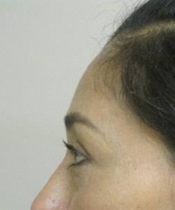 Blepharoplasty Patient 6 before photo. Individual results may vary.
