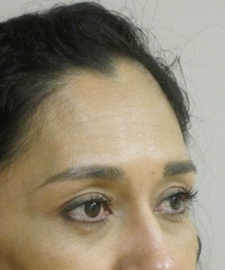 Blepharoplasty Patient 6 after photo. Individual results may vary.