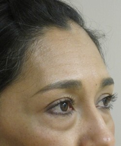 Blepharoplasty Patient 6 before photo. Individual results may vary.