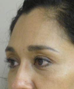 Blepharoplasty Patient 6 after photo. Individual results may vary.