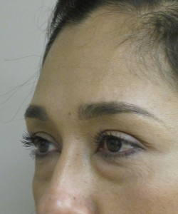 Blepharoplasty Patient 6 before photo. Individual results may vary.