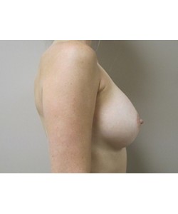 Breast Augmentation Patient 1 after photo. Individual results may vary.