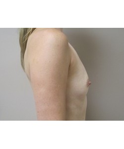 Breast Augmentation Patient 1 before photo. Individual results may vary.