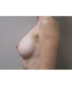 Breast Augmentation Patient 1 after photo. Individual results may vary.