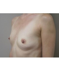 Breast Augmentation Patient 1 before photo. Individual results may vary.