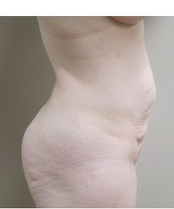 Tummy Tuck Patient 36 before photo. Individual results may vary.
