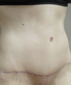 Tummy Tuck Patient 38 after photo. Individual results may vary.