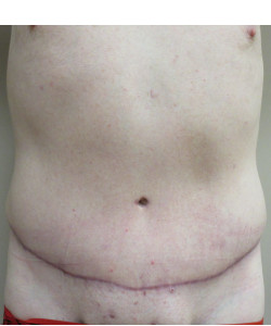 Tummy Tuck Exclusively Designed for Men - Eric S. Schaffer, MD FACS