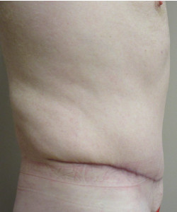 Male Tummy Tuck Patient 2 after photo. Individual results may vary.