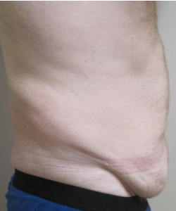 Male Tummy Tuck Patient 2 before photo. Individual results may vary.