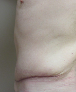 Male Tummy Tuck Patient 2 after photo. Individual results may vary.