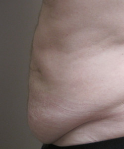 Male Tummy Tuck Patient 2 before photo. Individual results may vary.