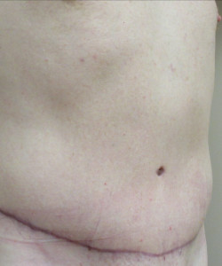 Male Tummy Tuck Patient 2 after photo. Individual results may vary.