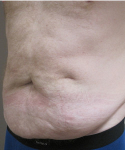 Male Tummy Tuck Patient 2 before photo. Individual results may vary.