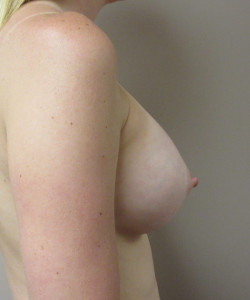 Breast Augmentation Patient 119 after photo. Individual results may vary.
