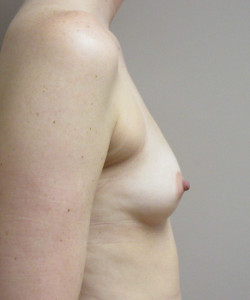Breast Augmentation Patient 119 before photo. Individual results may vary.