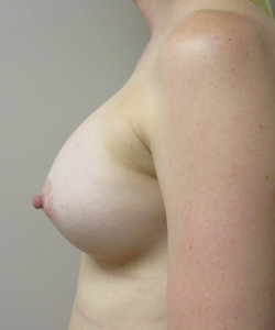 Breast Augmentation Patient 119 after photo. Individual results may vary.