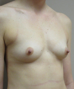 Breast Augmentation Patient 119 before photo. Individual results may vary.