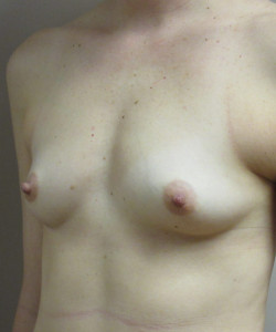 Breast Augmentation Patient 119 before photo. Individual results may vary.
