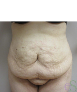Tummy Tuck  Before & After Gallery