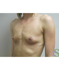 Breast Augmentation Patient 3 before photo. Individual results may vary.