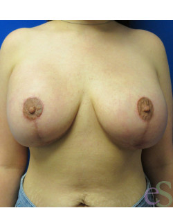 Breast Augmentation with Lift Patient 21 after photo. Individual results may vary.