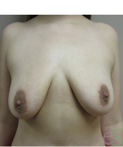 Breast Augmentation with Lift Patient 21 before photo. Individual results may vary.