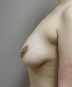 Breast Augmentation with Lift Patient 21 before photo. Individual results may vary.