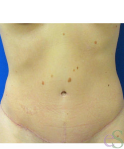 Tummy Tuck Patient 50 after photo. Individual results may vary.