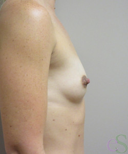 Breast Augmentation Patient 142 before photo. Individual results may vary.