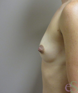 Breast Augmentation Patient 142 before photo. Individual results may vary.