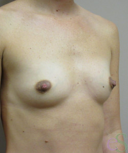 Breast Augmentation Patient 142 before photo. Individual results may vary.