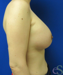 Breast Augmentation Patient 143 after photo. Individual results may vary.