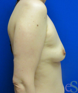 Breast Augmentation Patient 143 before photo. Individual results may vary.