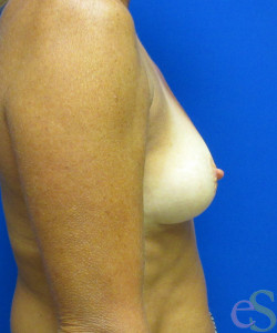 Breast Augmentation Patient 144 before photo. Individual results may vary.