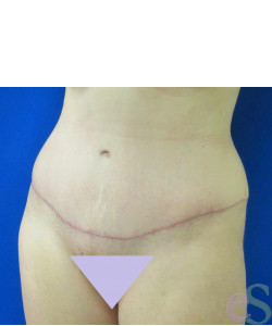 Tummy Tuck Patient 51 after photo. Individual results may vary.
