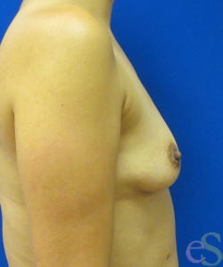 Breast Augmentation Patient 146 before photo. Individual results may vary.