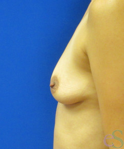 Breast Augmentation Patient 146 before photo. Individual results may vary.