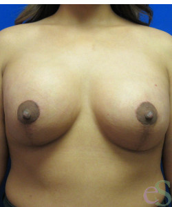 Breast Augmentation with Lift Patient 22 after photo. Individual results may vary.