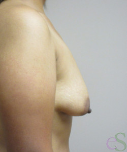 Breast Augmentation with Lift Patient 22 before photo. Individual results may vary.