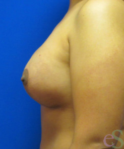 Breast Augmentation with Lift Patient 22 after photo. Individual results may vary.