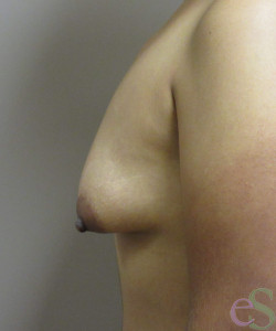 Breast Augmentation with Lift Patient 22 before photo. Individual results may vary.
